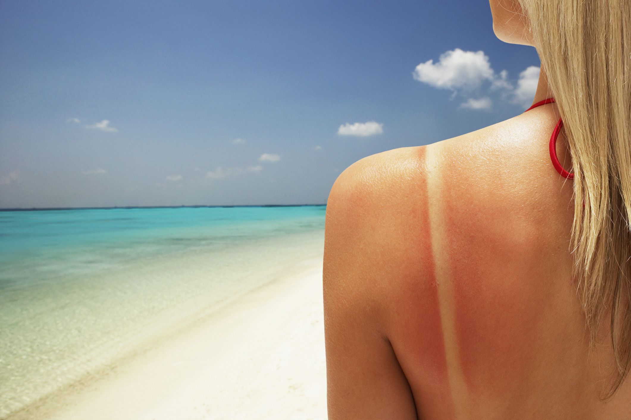 sunburn